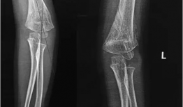 肘关节康复训练视频,全方位指导，轻松恢复运动能力